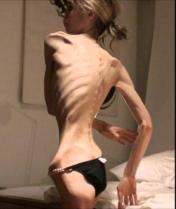 Plataforma Purple Day, para atender trastornos de la conducta alimentaria como bulimia y anorexia