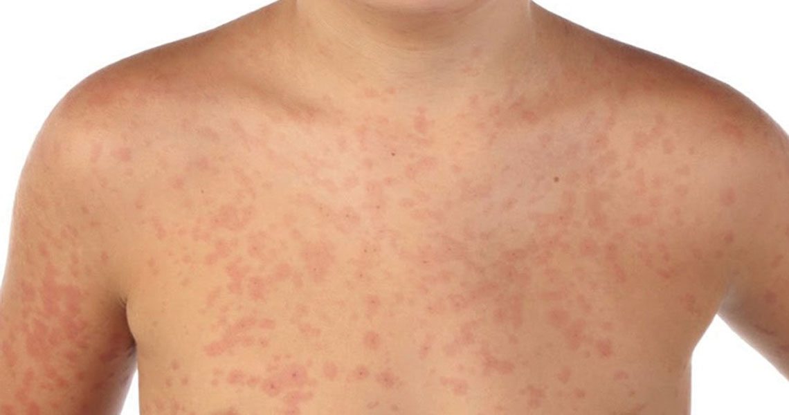 Detectan tres nuevos casos de sarampión en México