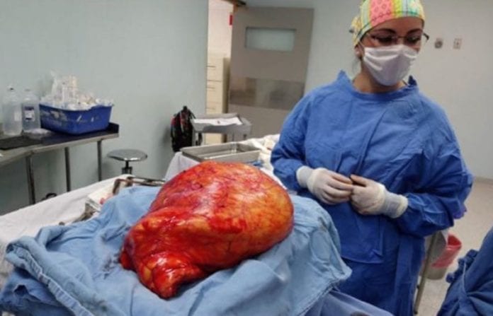 tumor de 17 kilos