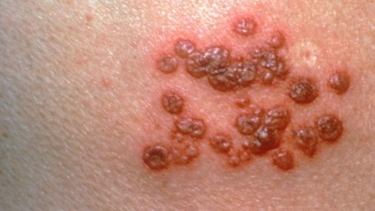 Manejo inadecuado del estrés puede provocar herpes zóster