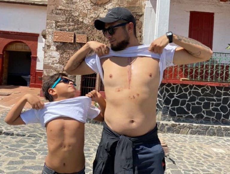 Existen historias entrañables de amor maternal, pero también paternal y es el caso de un padre de familia, quien, en su afán por mostrar su amor y solidaridad con su hijo, se tatuó una cicatriz igual a la de una cirugía de su hijo.