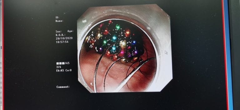 Niño dice comerse sólo 1 bolita magnética mientras veía TV pero ¡le extraen más de 100!