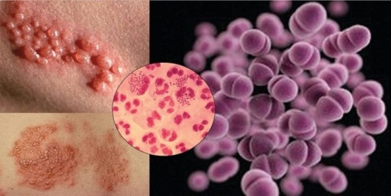 ‘Podría volverse intratable’: Alerta OMS por aumento de casos de supergonorrea