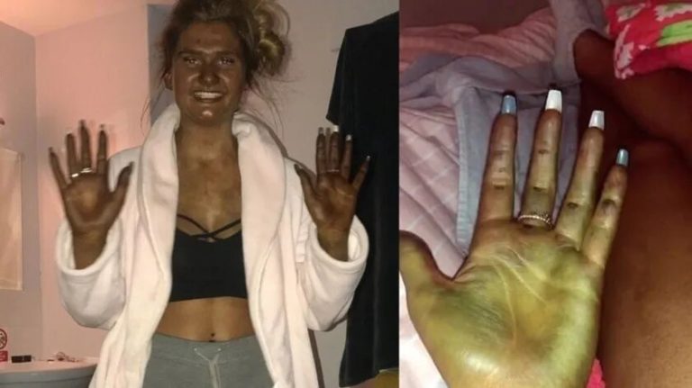 Se queda dormida mientras se bronceaba, termina verde y la llaman ‘Fiona’