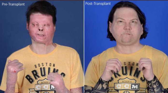 Es el primer caso exitoso de un trasplante de rostro y manos a la misma persona; se trata de un joven norteamericano de 22 años. Conócelo