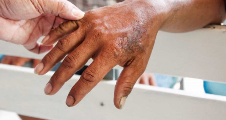 Primer caso de lepra en Qroo