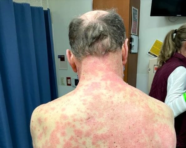 Abuelito de 70 años sufre de reacción en la piel luego de colocarse vacuna contra el Covid-19