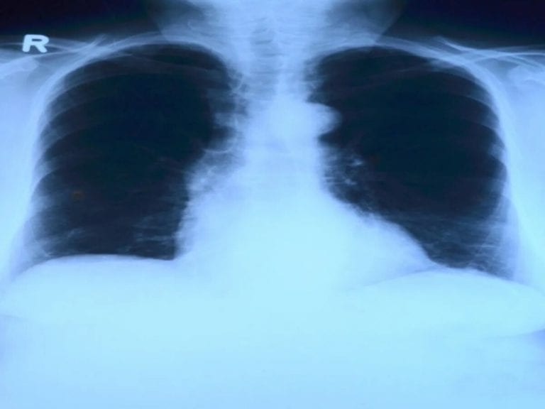 Encuentran un condón en el pulmón de mujer con tuberculosis, tenía mucha tos