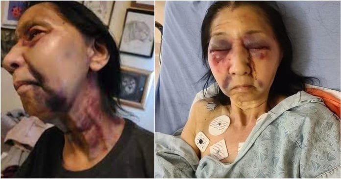 Fotos muestran lamentable estado de señora mexicana tras recibir tremenda golpiza racista en Los Ángeles