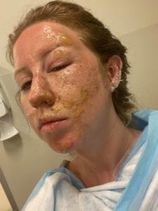 Quemaduras de Marissa Daniel