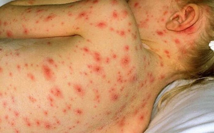 Anticipan brote de varicela en la Zona Maya de Quintana Roo