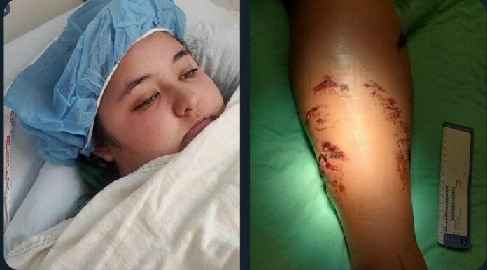 Un nuevo ataque de cocodrilo en México, en Puerto Vallarta; esta vez la víctima fue una joven de Estados Unidos