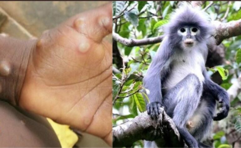 Detectan caso de viruela de mono en Texas; usar cubrebocas evita contagio