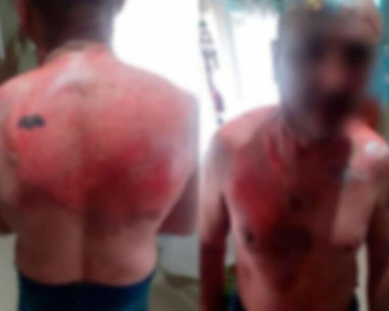 Le echa agua hirviendo a su exesposo por dejarla provocándole serias quemaduras