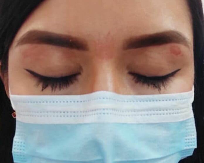 Joven denuncia a salón de belleza en Mérida por quemarle los párpados