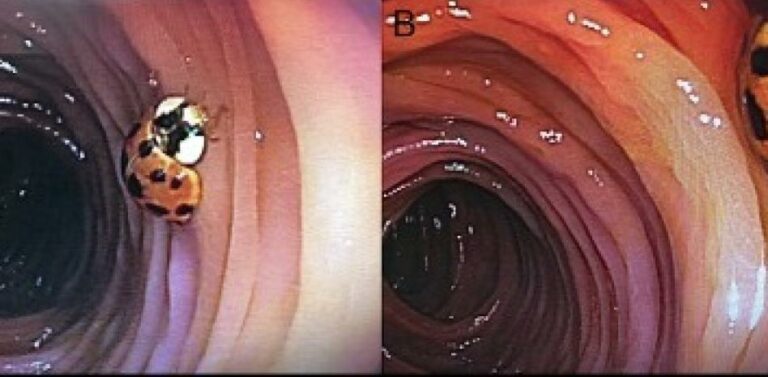 FOTOS: Descubren a una mariquita viviendo en el intestino de un hombre durante colonoscopia