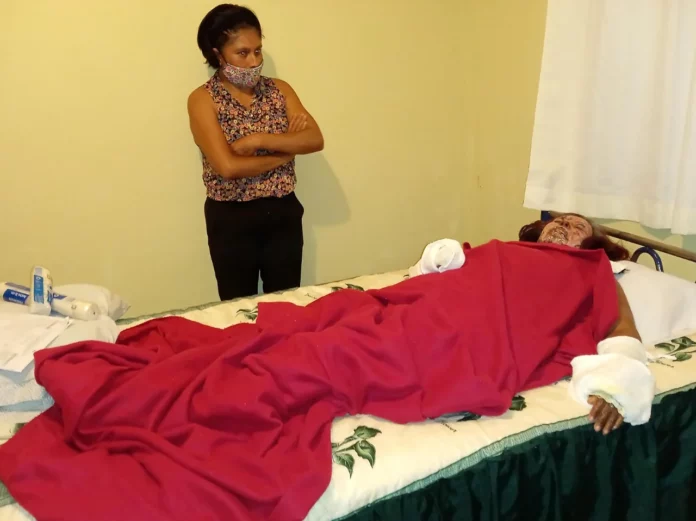 Olivia, mujer quemada con aceite, quiere que su agresor vea su rostro y que se cuente su historia