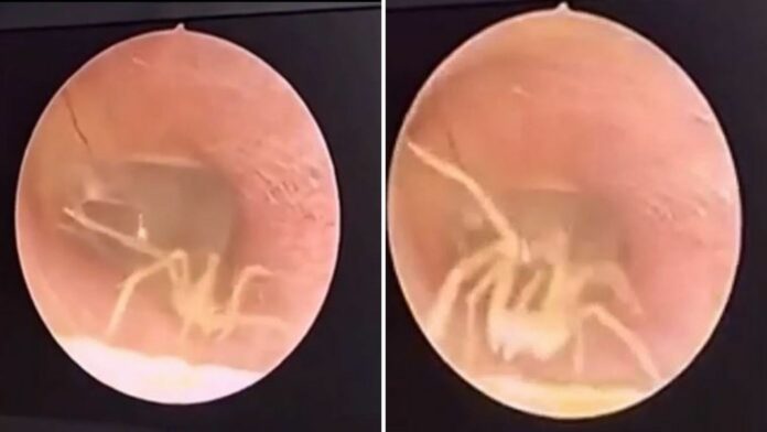 Extraen araña viva del oído de una mujer, tenía rato con un 'fuerte dolor'