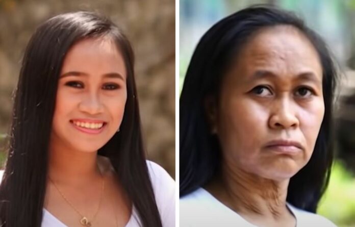 Joven de 16 años aparenta tener 50 por un trastorno genético