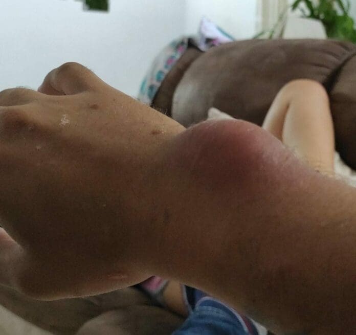 Una bacteria casi le quita la vida a un joven, quien todo lo que hizo fue meterse a nadar a una alberca cuya agua estaba sucia