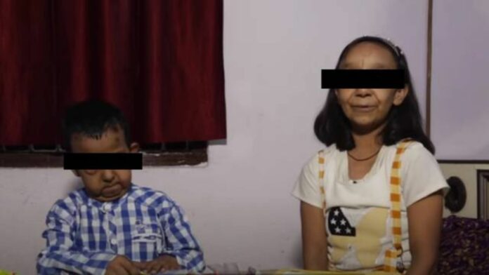 ¡Increíble! Hermanos de 5 y 11 años parecen viejitos por un trastorno genético