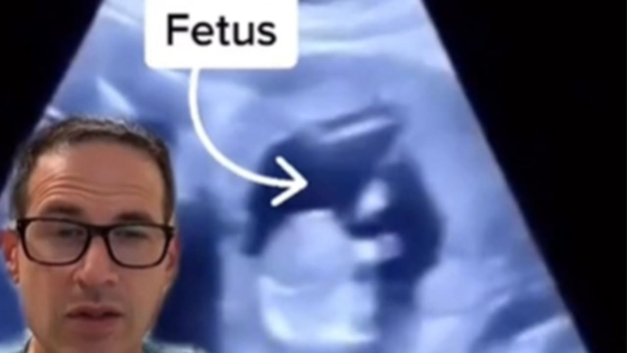 VIDEO DE EMBARAZO EXTREMO: Bebé crece en el hígado de su mamá