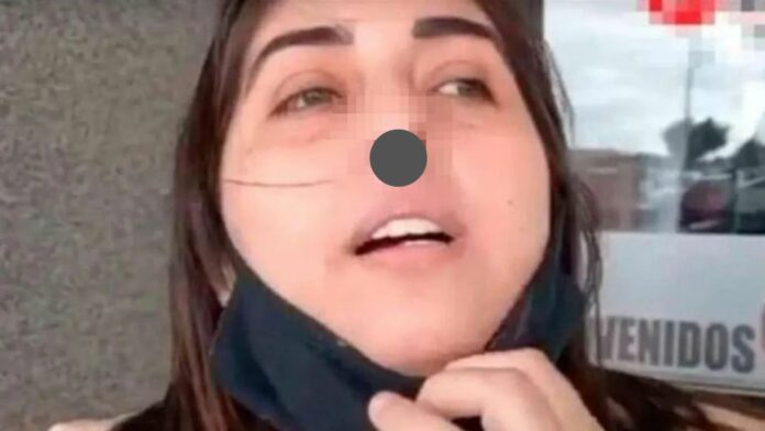 Una mujer perdió el cartílago de su nariz luego se someterse a un hisopado de Covid-19, desde hace cinco meses espera porque le den una solución al problema de salud que presenta.