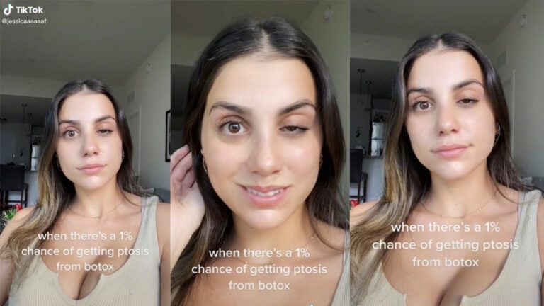 Joven se hace tratamiento de bótox pero termina con el párpado caído