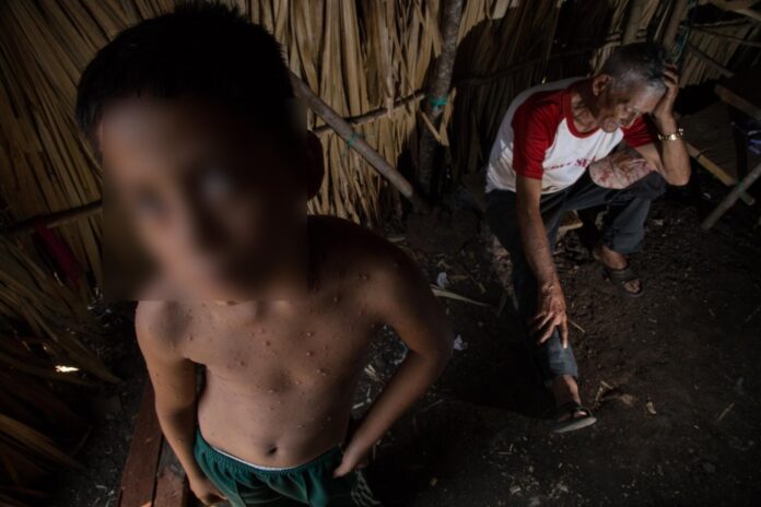 Yucatán ocupa posición 14 en casos de varicela en México