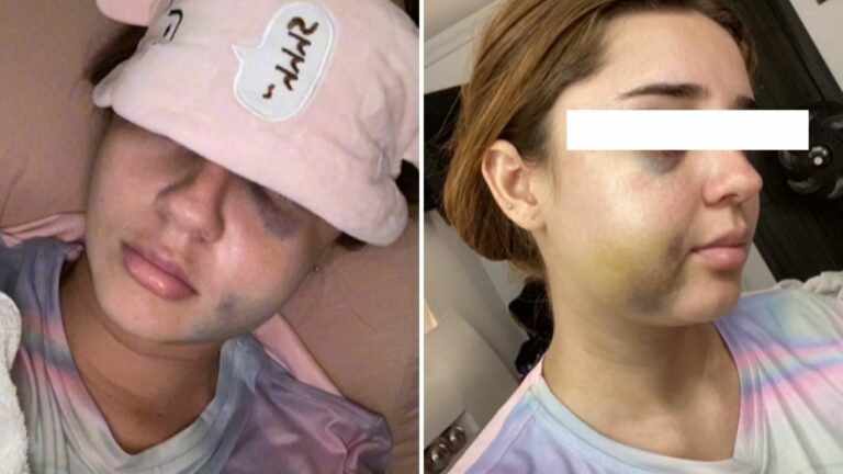 Joven estuvo a punto de perder la vida por cirugía estética mal hecha