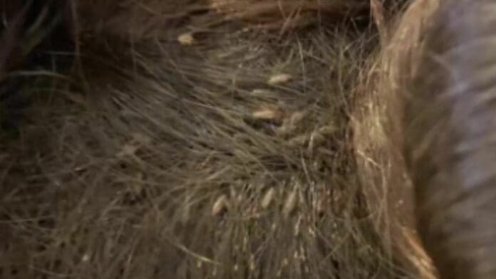 VIDEO: Revelan impactante caso de pediculosis en una niña, tardaron 9 horas en curarla