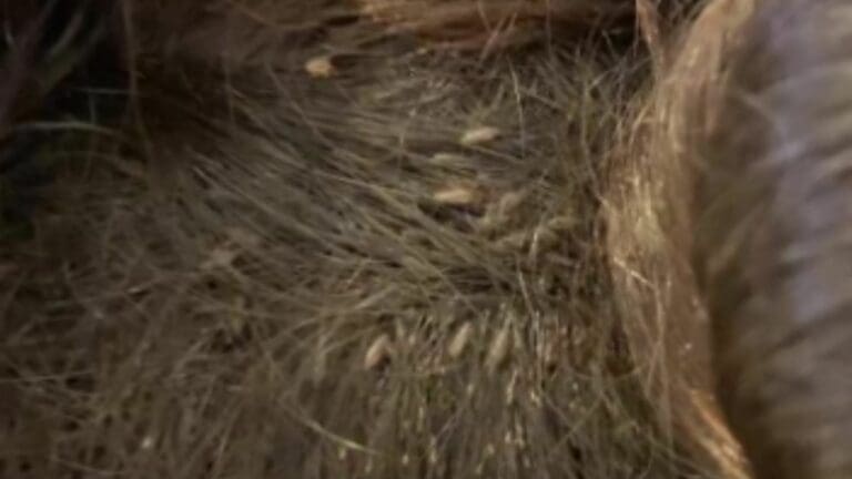 VIDEO: Revelan impactante caso de pediculosis en una niña, tardaron 9 horas en curarla