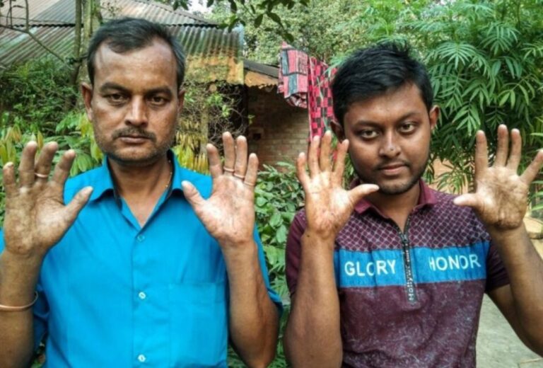 La familia tiene una rara condición: no tienen huellas dactilares y esta es la razón