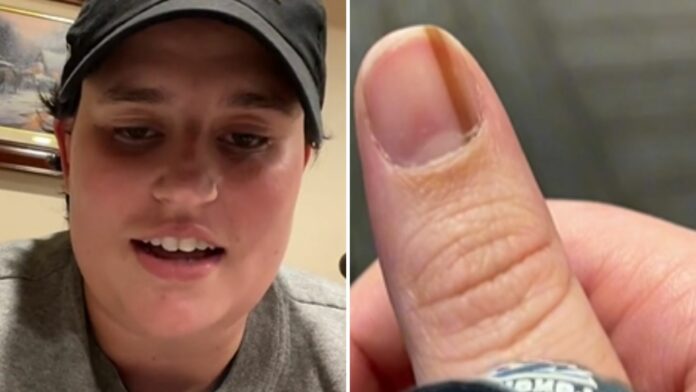 Tiktoker tenía una mancha en la uña que le 'parecía cool' por 10 años, era un cáncer