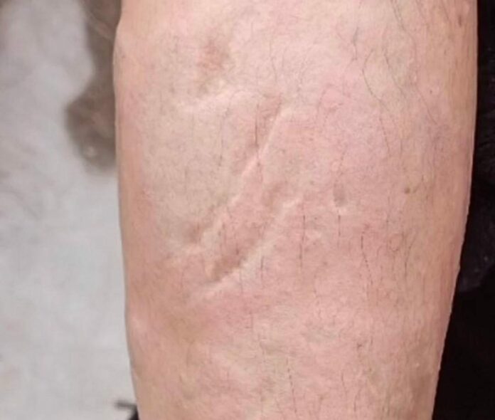 Alertan en internet por un ataque con ácido a una mujer en Puebla; piden tener cuidado para evitar ser víctima de algo similar. Foto: Redes sociales