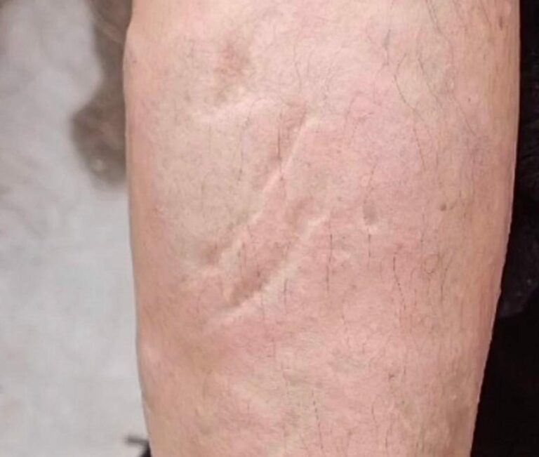 Alertan en internet por un ataque con ácido a una mujer en Puebla; piden tener cuidado para evitar ser víctima de algo similar. Foto: Redes sociales