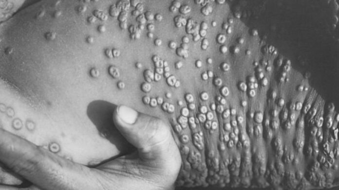 Detecta Argentina primer caso de viruela símica en América Latina