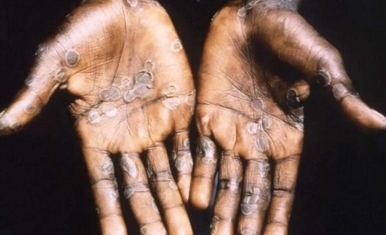 Van 5 casos confirmados de viruela del mono en Jalisco