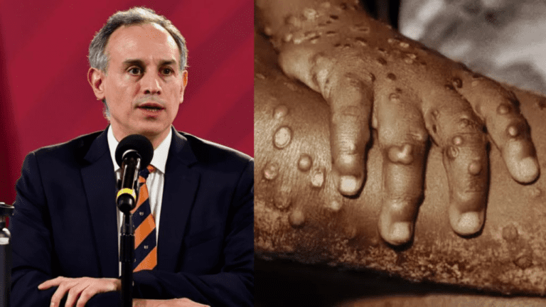 Secretaría de Salud analiza posible contagio comunitario de viruela del mono en México