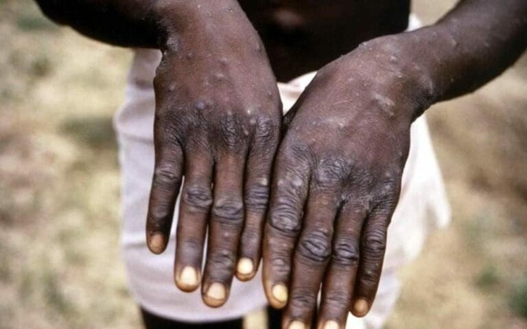 Hay alerta por un caso de viruela de mono en Jalisco; ya hay prueba PCR y se esperan resultados que confirmen. Es un turista. Foto: AFP (imagen referencial)