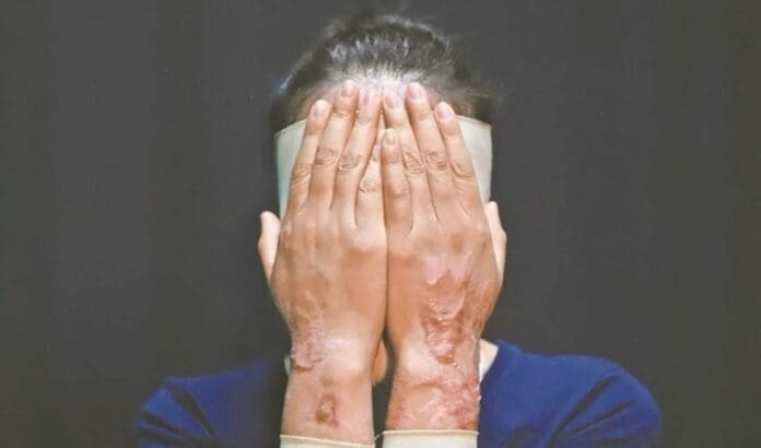 Activistas alertan por el considerable aumento el el número de ataques con ácido a mujeres en varias entidades en México.