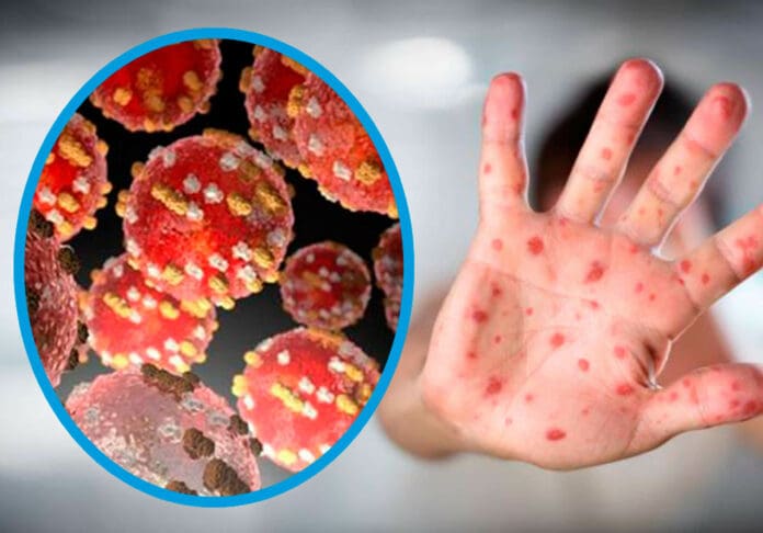 ÚLTIMO MOMENTO: La OMS declara la viruela del mono como emergencia sanitaria internacional