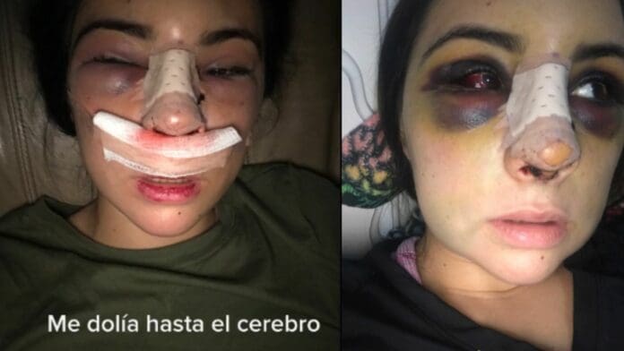 Video: Joven se hace viral tras mostrar su apariencia luego de una rinoplastia