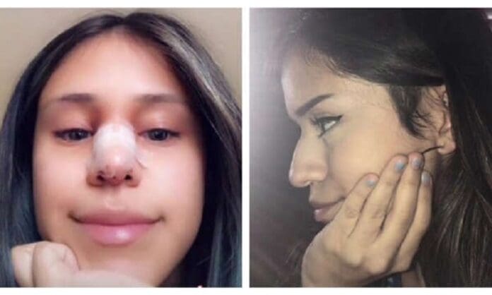 Joven perdona infidelidad de su novio a cambio de una cirugía de nariz