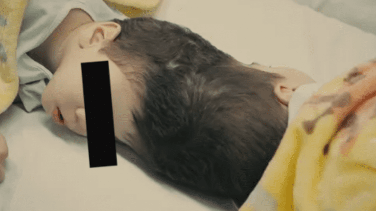 Logran con éxito separación de siameses unidos por la cabeza en Brasil