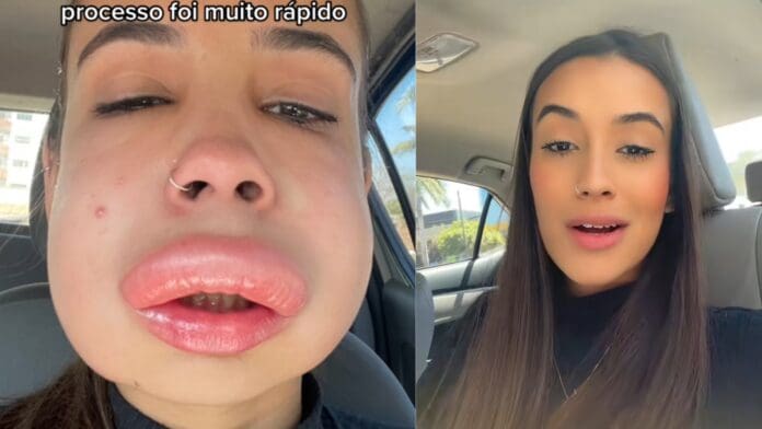 VIDEO: Mujer termina con terrible reacción alérgica tras inyectarse los labios
