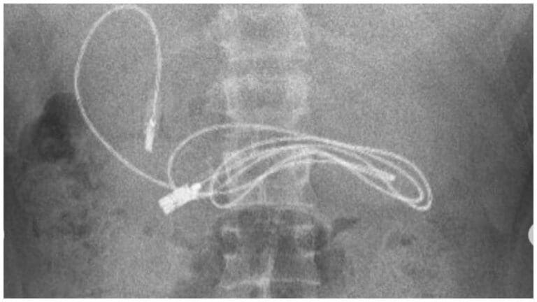 Joven va al médico por dolor en el estómago; tenía un cable de carga dentro