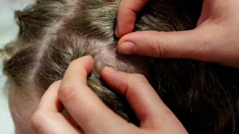 El brote de piojos en escuelas de Solidaridad ha sido recurrente, por lo que maestros hacen revisiones periódicas para tratar de erradicarlo.