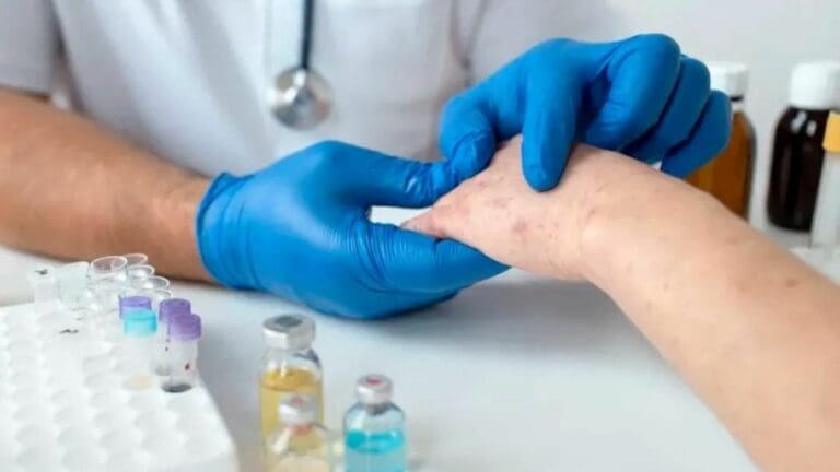 Se reportaron tres casos de viruela símica en enero de 2023 en Playa del Carmen