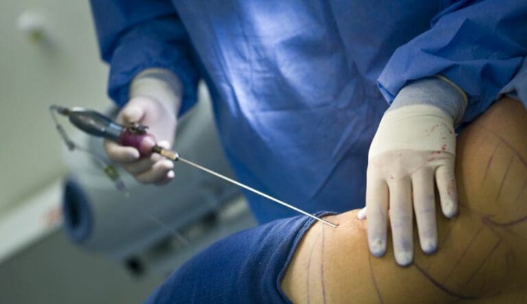 Enfermera fallece tras hacerse una autoliposucción en Morelos